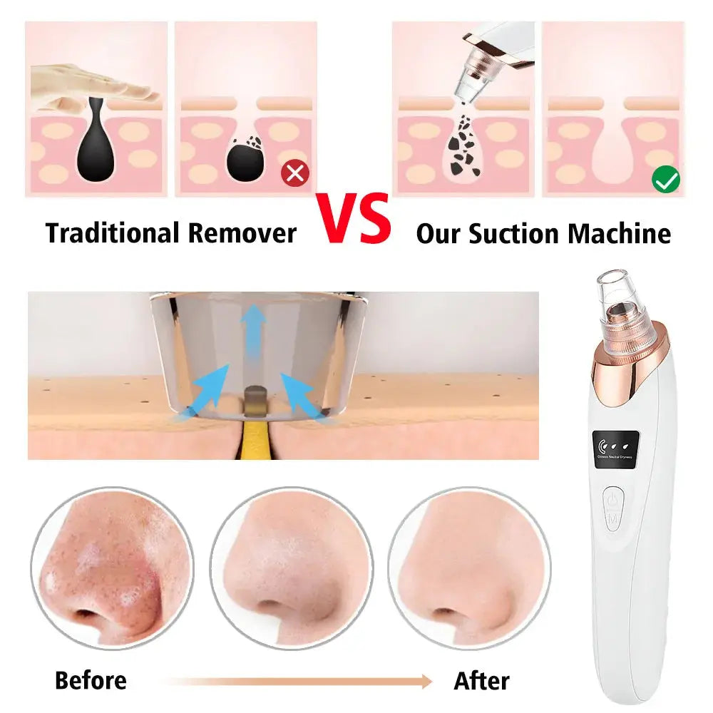 Blackhead Vacuum Pore Cleaner Tool جهاز شفط الرؤوس السوداء