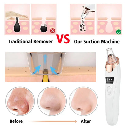 Blackhead Vacuum Pore Cleaner Tool جهاز شفط الرؤوس السوداء